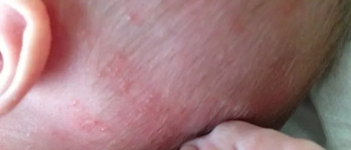 Pryschi Na Golove U Rebenka Prichiny Lechenie Profilaktika 1