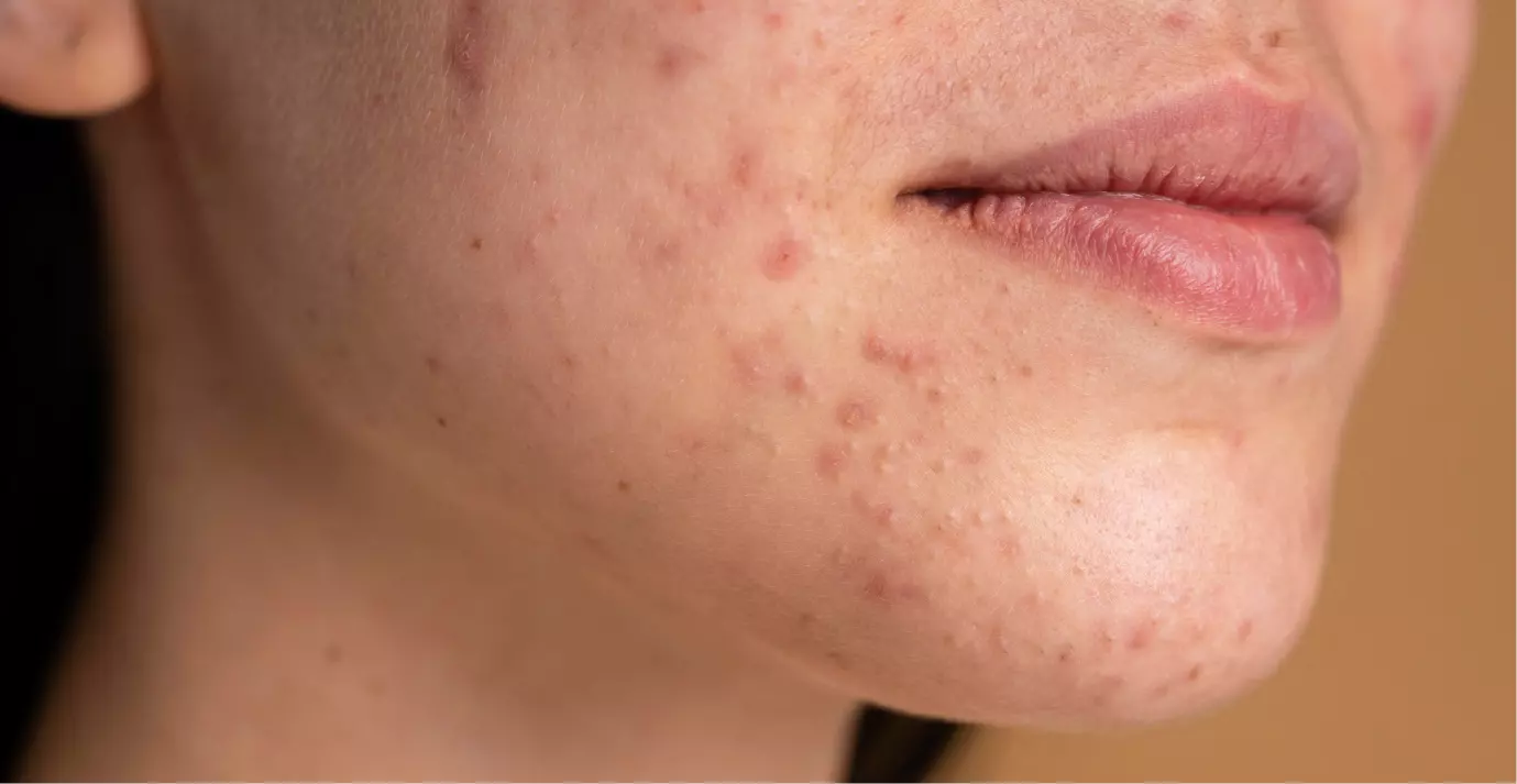 Chto Takoe Demodekoz 7 4