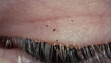 Yak Vyglyadaye Pidshkirnyj Klishh U Lyudej